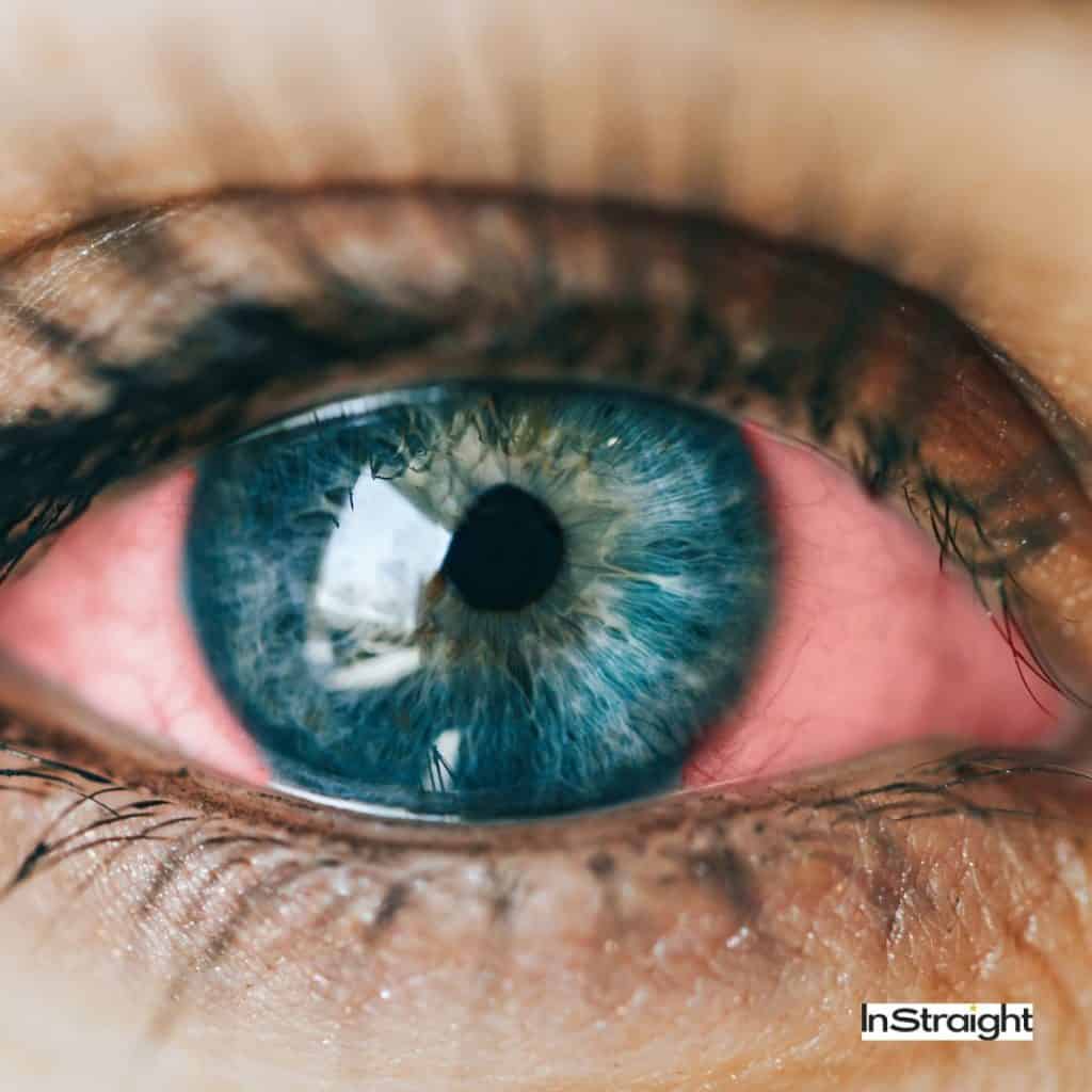 red eyes under title Why Does Keratin Burn My Eyes?